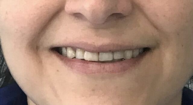 CEREC 1 SESIÓN antes